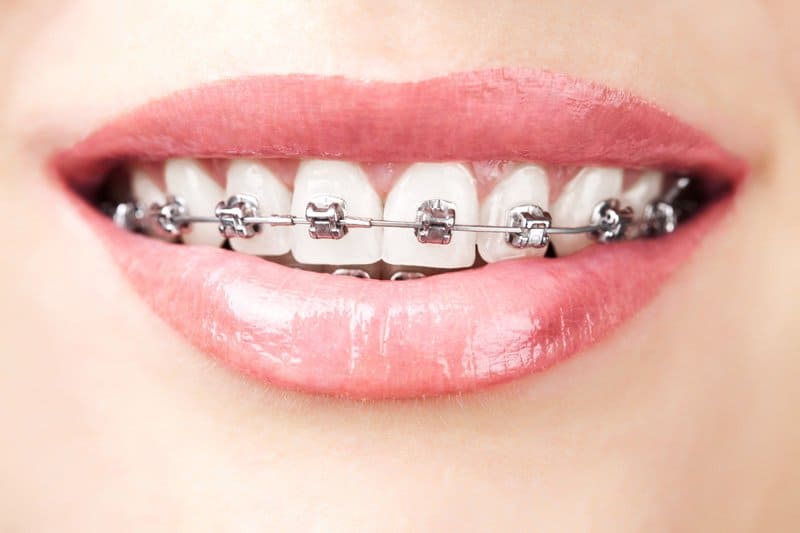 teeth with braces - Idaho Falls orthodontic treatment