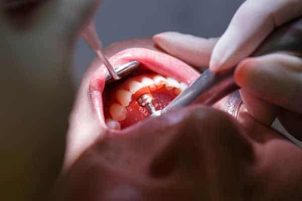 Man getting his teeth checked at dentist
