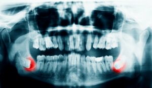 What You Need To Know About Wisdom Teeth