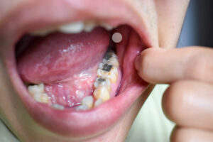 tooth structure exposure to mercury