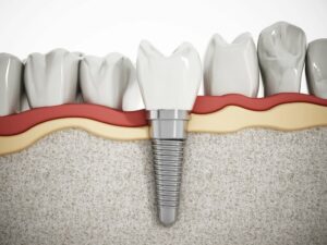 Dental Bridging and Implants