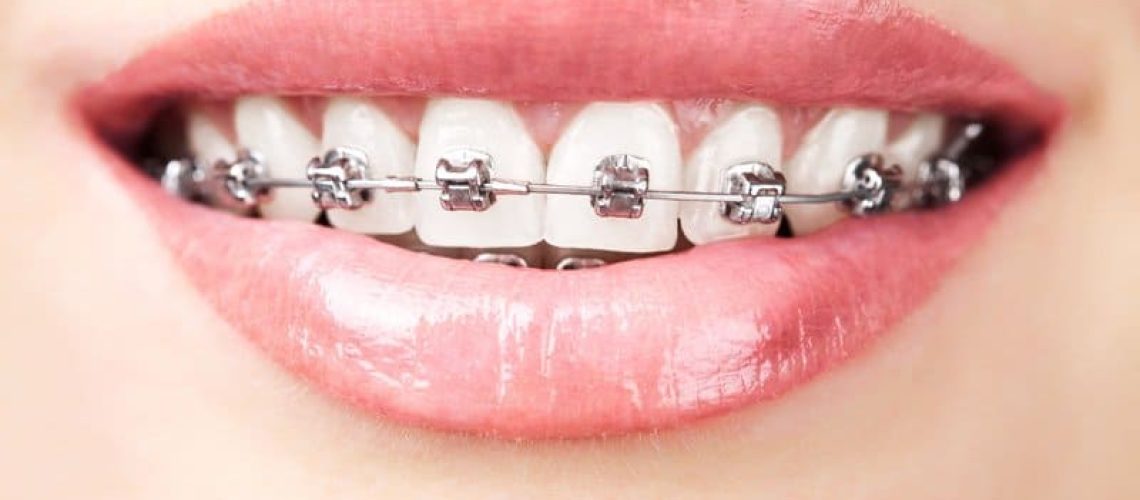 teeth with braces
