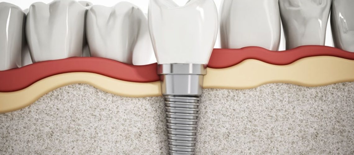 dental-implant-virtual