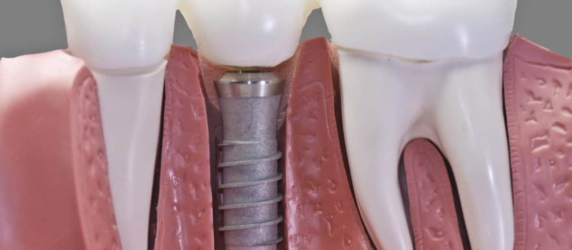 This model show the teeth have been capped and the stainless pin in the gums.